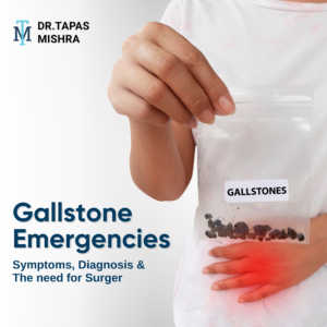 Gallstone Emergencies: Symptoms, Diagnosis & The Need for Surgery