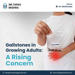 Gallstones in Growing Adults: A Rising Concern.