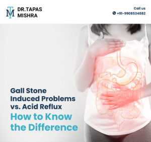 Gallstone Induced Problems Vs Acid Reflux  –  How to Know the Difference ?