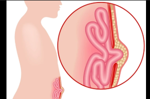 Intestinal and abdominal wall problems