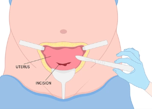 Umbilical incision illustration