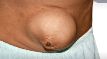 Large abdominal hernia illustration