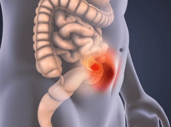 Recurrent hernia illustration